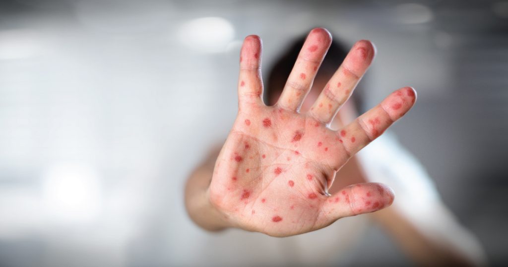 Korona virus COVID-19 – Nove informacije, najčešća pitanja i odgovori 5 male boginje