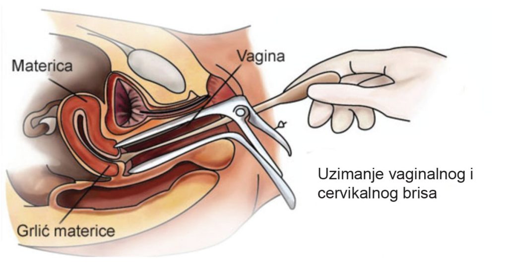 Infekcija kandidom – uzroci, simptomi i dijagnostika kandidijaze 1 cevikalni bris